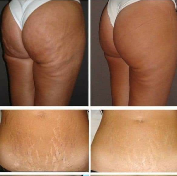 Dermatic Effects Cellulite Cream - Picture 6 of 6